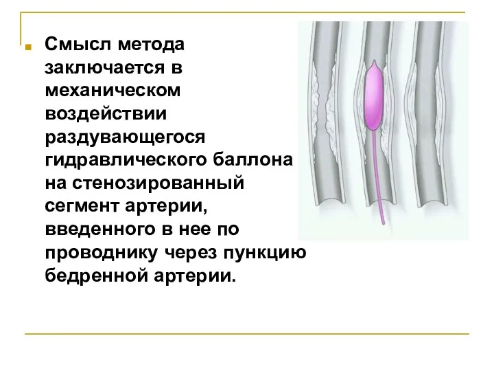 Смысл метода заключается в механическом воздействии раздувающегося гидравлического баллона на