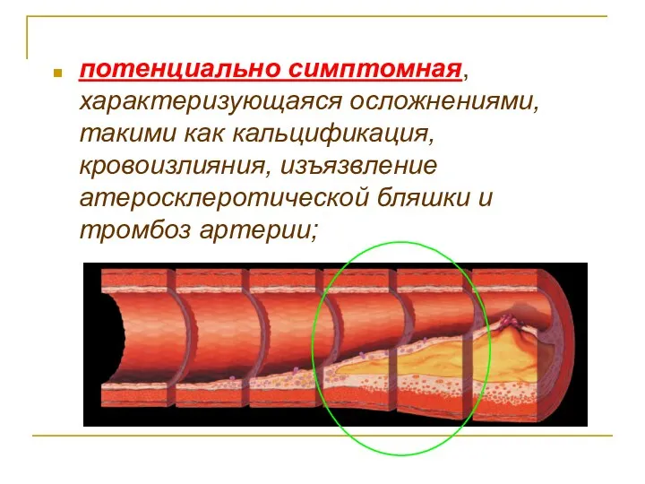 потенциально симптомная, характеризующаяся осложнениями, такими как кальцификация, кровоизлияния, изъязвление атеросклеротической бляшки и тромбоз артерии;