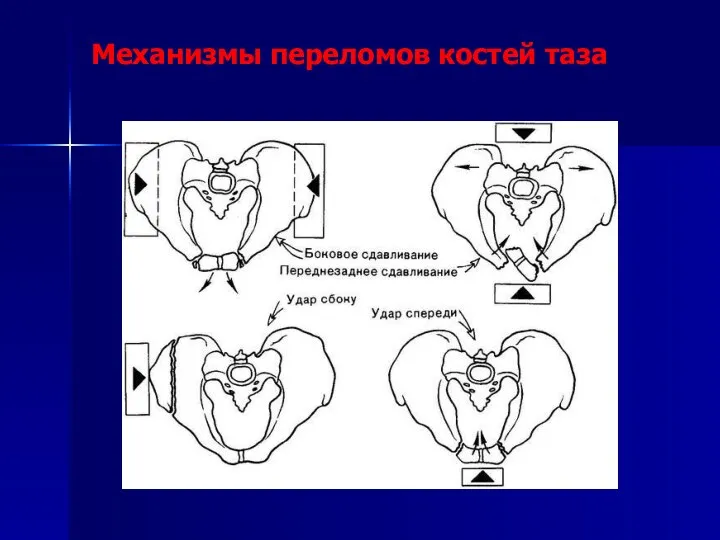 Механизмы переломов костей таза