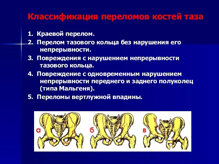 1. Краевой перелом. 2. Перелом тазового кольца без нарушения его