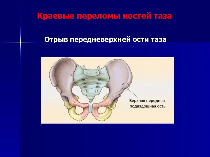 Краевые переломы костей таза Отрыв передневерхней ости таза