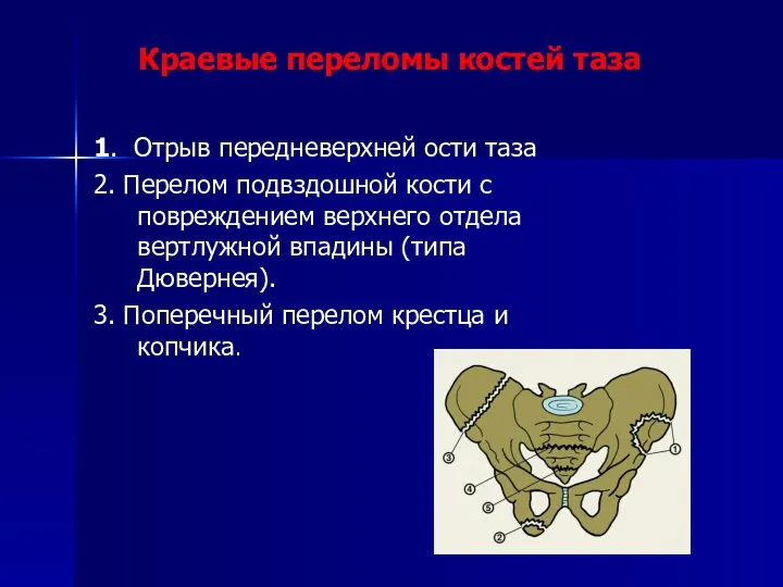 Краевые переломы костей таза 1. Отрыв передневерхней ости таза 2.