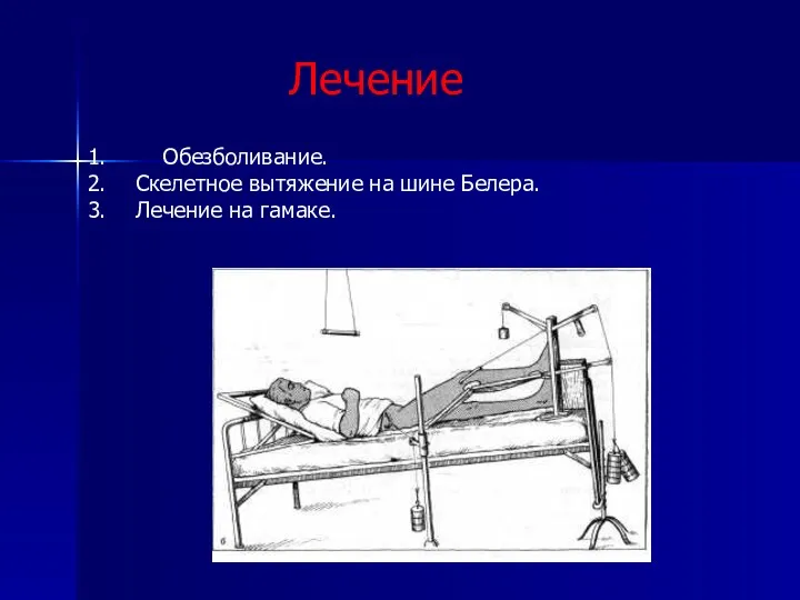 Лечение Обезболивание. Скелетное вытяжение на шине Белера. Лечение на гамаке.