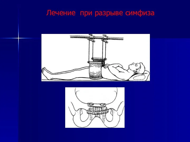 Лечение при разрыве симфиза