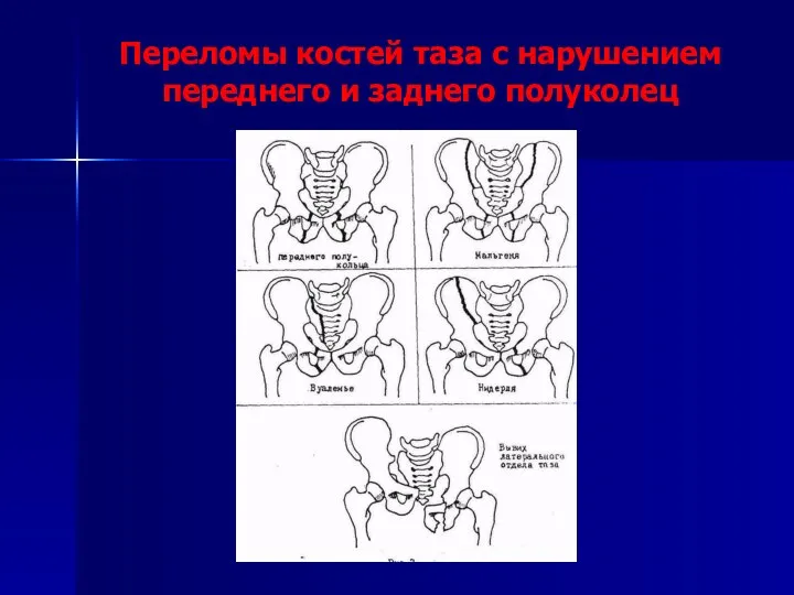 Переломы костей таза с нарушением переднего и заднего полуколец