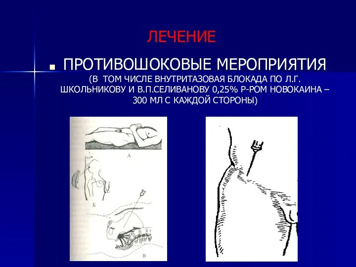 ЛЕЧЕНИЕ ПРОТИВОШОКОВЫЕ МЕРОПРИЯТИЯ (В ТОМ ЧИСЛЕ ВНУТРИТАЗОВАЯ БЛОКАДА ПО Л.Г.ШКОЛЬНИКОВУ