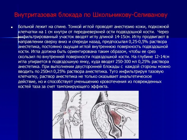 Внутритазовая блокада по Школьникову-Селиванову Больной лежит на спине. Тонкой иглой