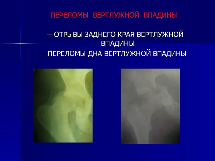 ПЕРЕЛОМЫ ВЕРТЛУЖНОЙ ВПАДИНЫ ─ ОТРЫВЫ ЗАДНЕГО КРАЯ ВЕРТЛУЖНОЙ ВПАДИНЫ ─ ПЕРЕЛОМЫ ДНА ВЕРТЛУЖНОЙ ВПАДИНЫ