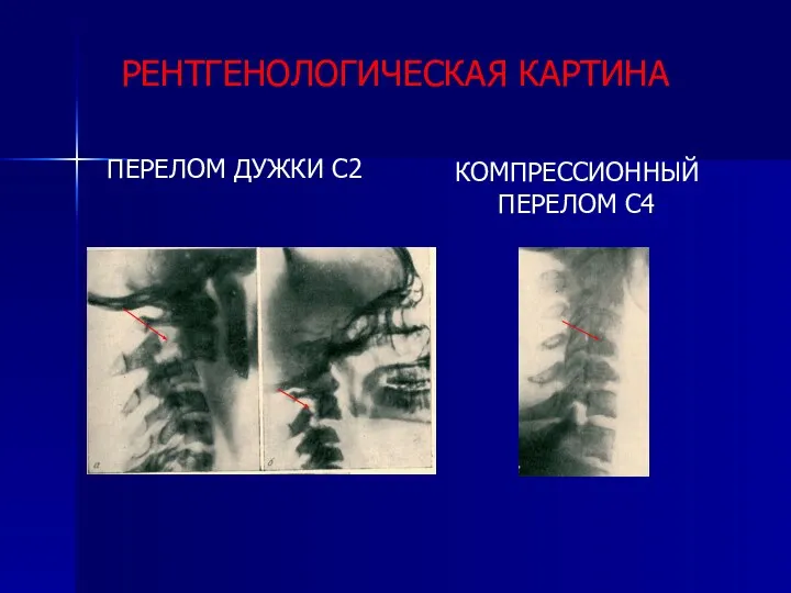 РЕНТГЕНОЛОГИЧЕСКАЯ КАРТИНА ПЕРЕЛОМ ДУЖКИ С2 КОМПРЕССИОННЫЙ ПЕРЕЛОМ С4