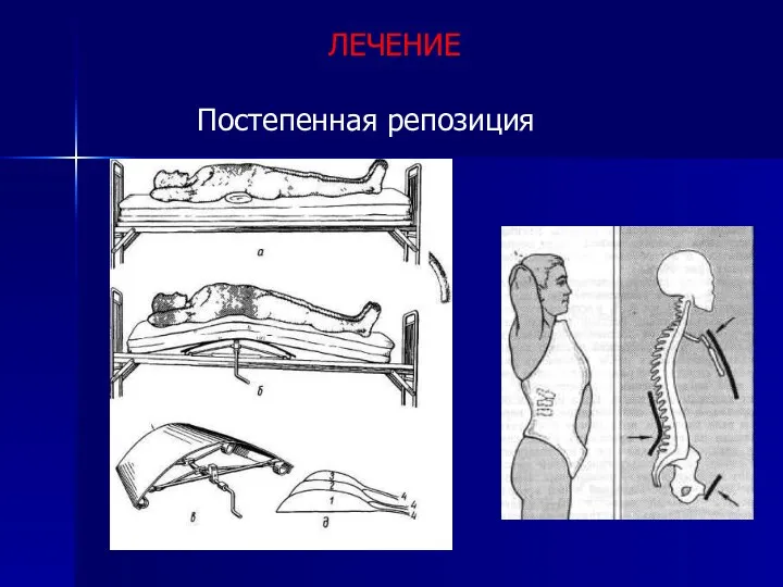 ЛЕЧЕНИЕ Постепенная репозиция