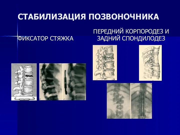 СТАБИЛИЗАЦИЯ ПОЗВОНОЧНИКА ФИКСАТОР СТЯЖКА ПЕРЕДНИЙ КОРПОРОДЕЗ И ЗАДНИЙ СПОНДИЛОДЕЗ