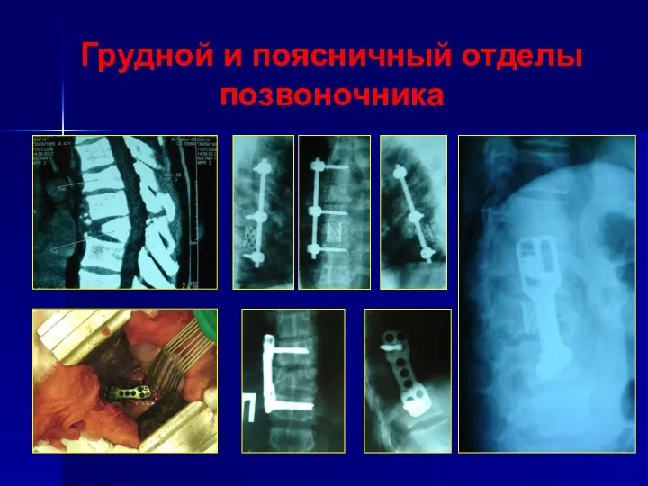 Грудной и поясничный отделы позвоночника