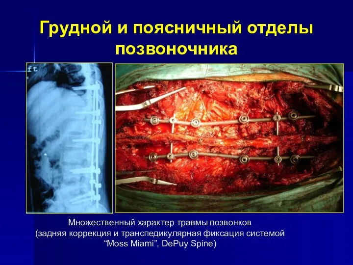 Грудной и поясничный отделы позвоночника Множественный характер травмы позвонков (задняя