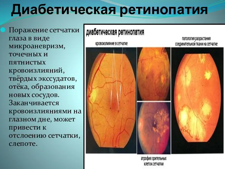 Диабетическая ретинопатия Поражение сетчатки глаза в виде микроаневризм, точечных и