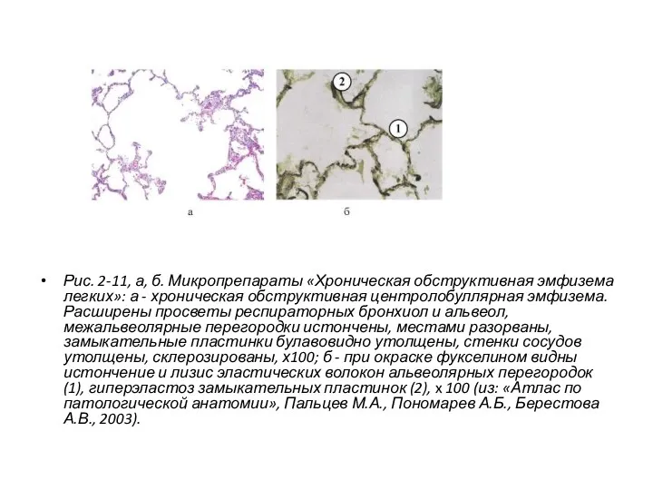Рис. 2-11, а, б. Микропрепараты «Хроническая обструктивная эмфизема легких»: а