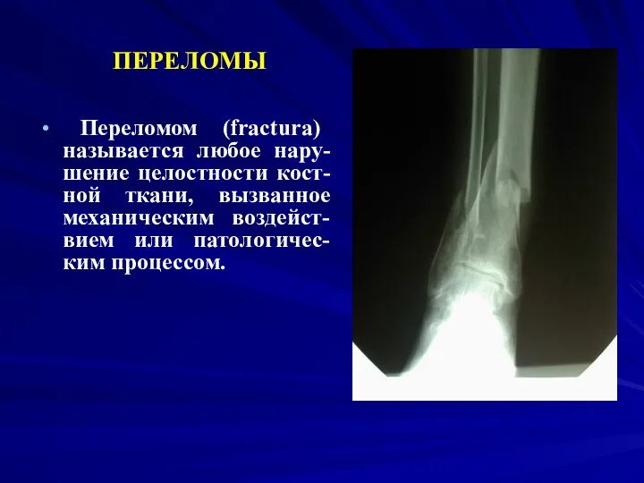 ПЕРЕЛОМЫ Переломом (fracturа) называется любое нару-шение целостности кост-ной ткани, вызванное механическим воздейст-вием или патологичес-ким процессом.