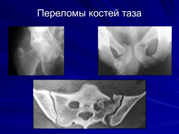 Переломы костей таза