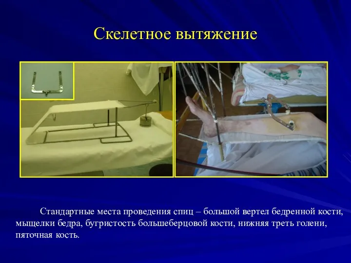 Скелетное вытяжение Стандартные места проведения спиц – большой вертел бедренной