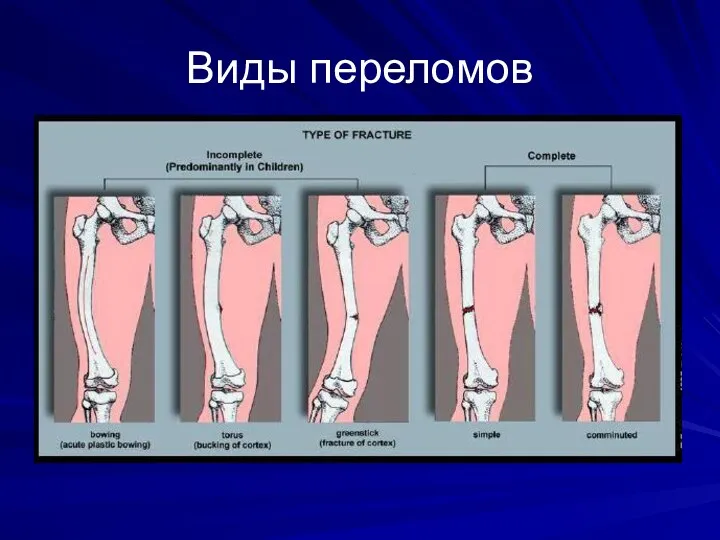 Виды переломов