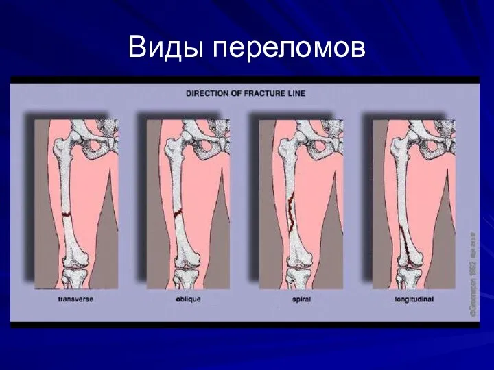 Виды переломов