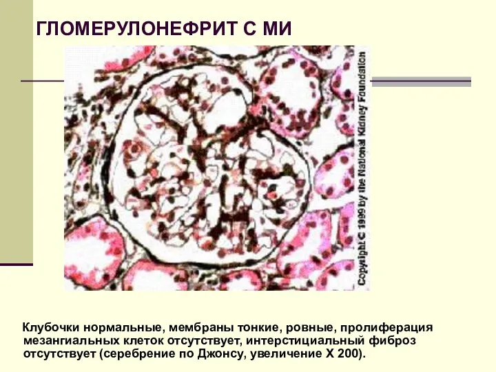 ГЛОМЕРУЛОНЕФРИТ С МИ Клубочки нормальные, мембраны тонкие, ровные, пролиферация мезангиальных