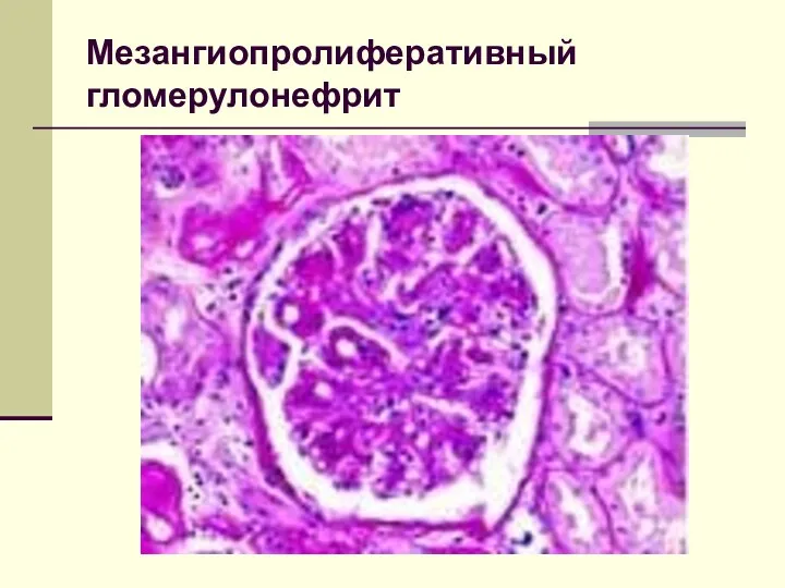 Мезангиопролиферативный гломерулонефрит