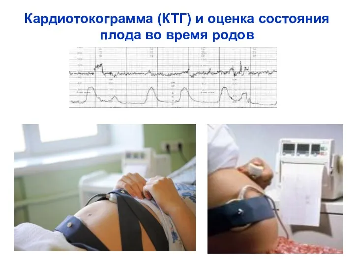 Кардиотокограмма (КТГ) и оценка состояния плода во время родов