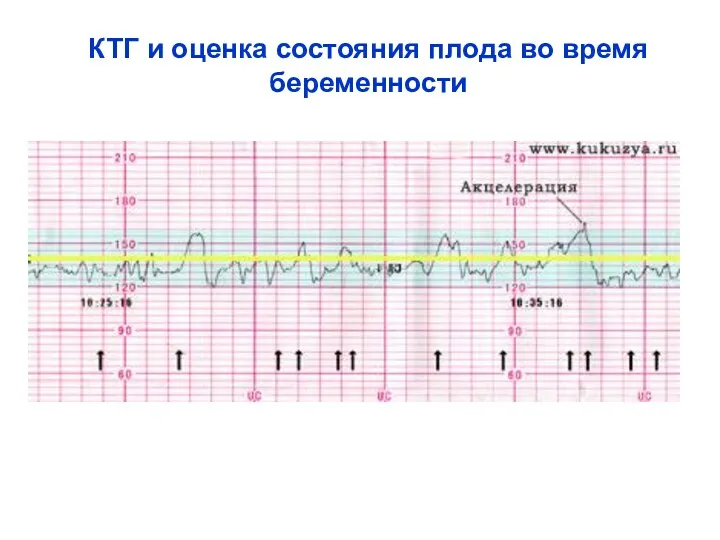 КТГ и оценка состояния плода во время беременности