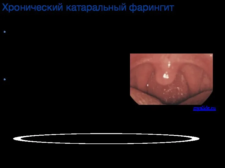 Хронический катаральный фарингит Жалобы При обострении - боль в горле
