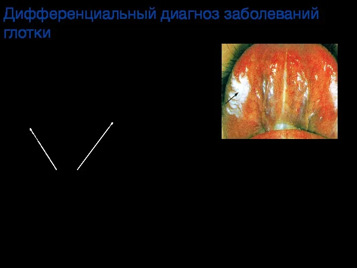 Дифференциальный диагноз заболеваний глотки Волосатая лейкоплакия – абсолютный признак ВИЧ-