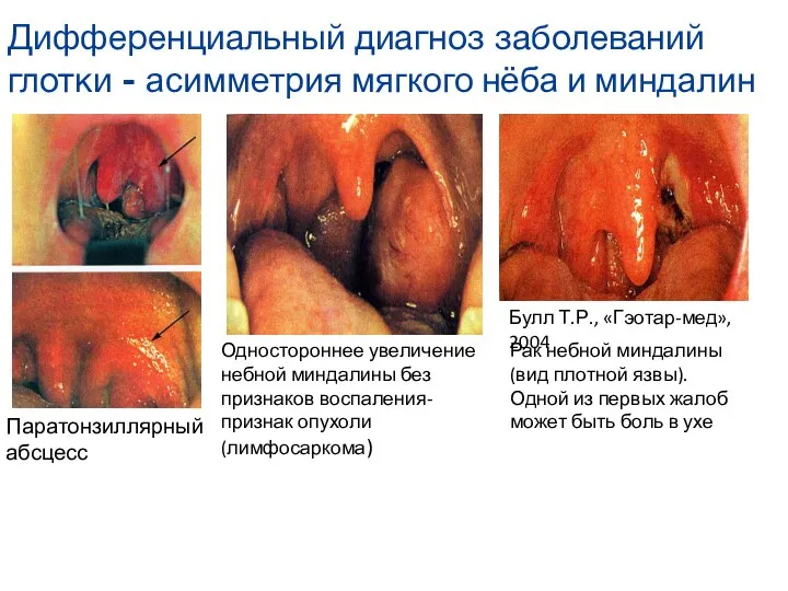 Паратонзиллярный абсцесс Одностороннее увеличение небной миндалины без признаков воспаления- признак