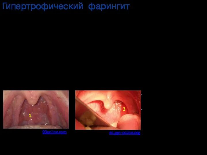 Гипертрофический фарингит 03online.com en.ppt-online.org Фарингоскопическая картина при гранулёзном фарингите и