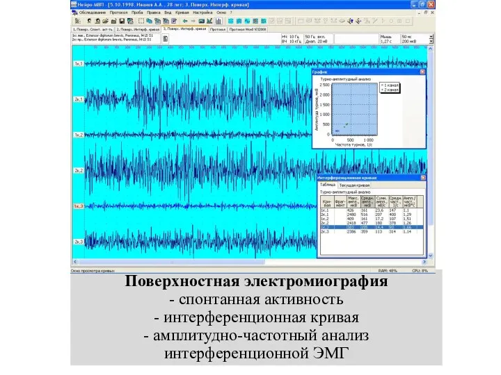 Поверхностная электромиография - спонтанная активность - интерференционная кривая - амплитудно-частотный анализ интерференционной ЭМГ
