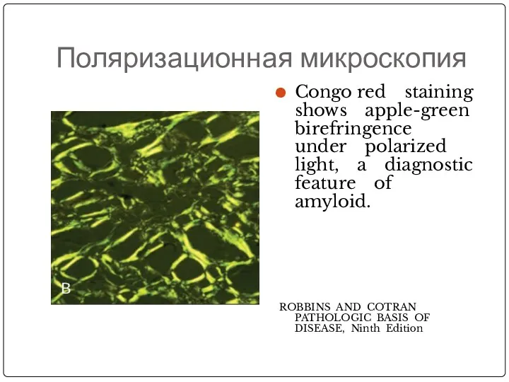 Поляризационная микроскопия Congo red staining shows apple-green birefringence under polarized light, a diagnostic