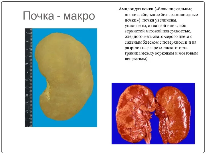 Почка - макро Амилоидоз почки («большие сальные почки», «большие белые