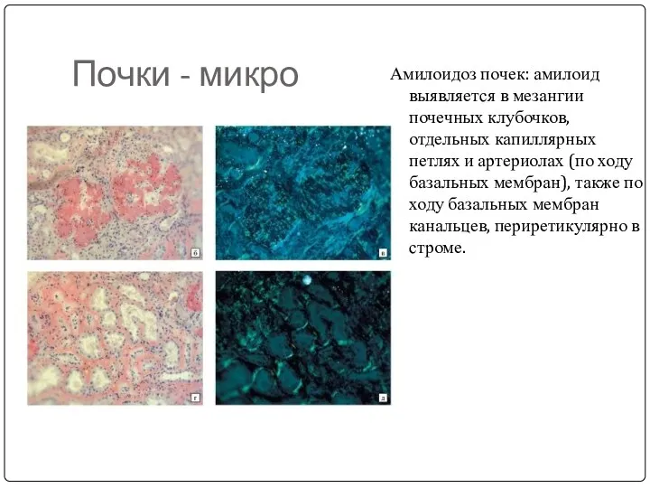 Почки - микро Амилоидоз почек: амилоид выявляется в мезангии почечных