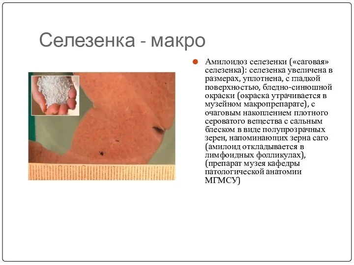 Селезенка - макро Амилоидоз селезенки («саговая» селезенка): селезенка увеличена в размерах, уплотнена, с