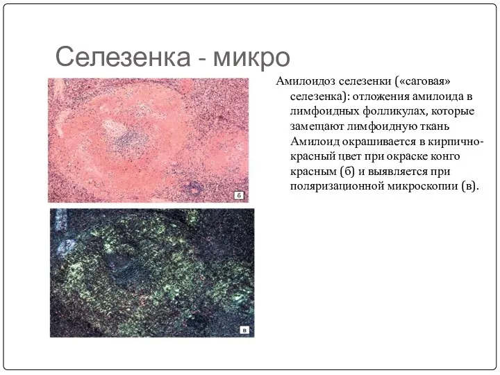 Селезенка - микро Амилоидоз селезенки («саговая» селезенка): отложения амилоида в лимфоидных фолликулах, которые