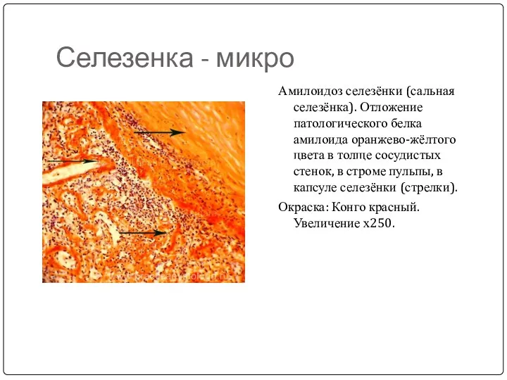 Селезенка - микро Амилоидоз селезёнки (сальная селезёнка). Отложение патологического белка амилоида оранжево-жёлтого цвета