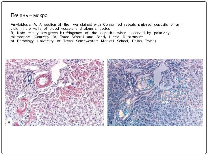 Печень – микро Amyloidosis. A, A section of the liver stained with Congo