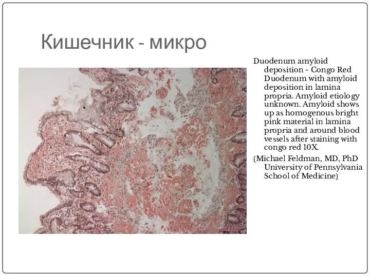 Кишечник - микро Duodenum amyloid deposition - Congo Red Duodenum with amyloid deposition