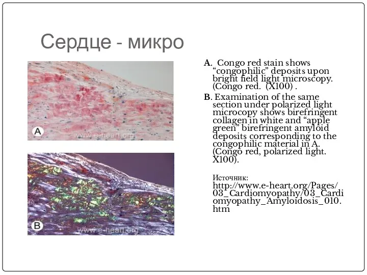 Сердце - микро A. Congo red stain shows “congophilic” deposits upon bright field