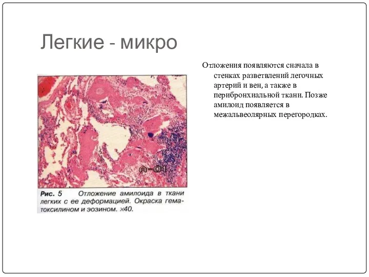 Легкие - микро Отложения появляются сначала в стенках разветвлений легочных артерий и вен,