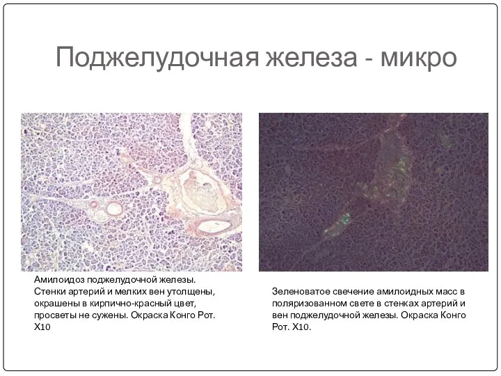 Поджелудочная железа - микро Амилоидоз поджелудочной железы. Стенки артерий и