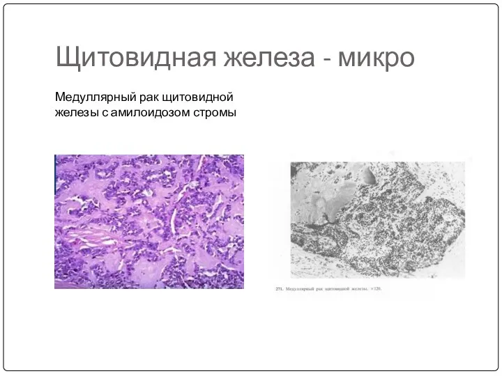 Щитовидная железа - микро Медуллярный рак щитовидной железы с амилоидозом стромы