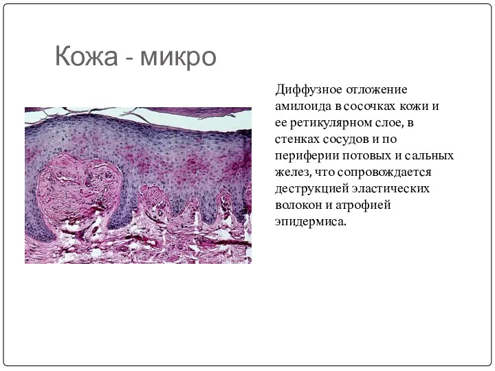 Кожа - микро Диффузное отложение амилоида в сосочках кожи и ее ретикулярном слое,