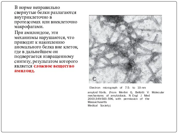 Electron micrograph of 7.5- to 10-nm amyloid fibrils. (From Merlini G, Bellotti V: