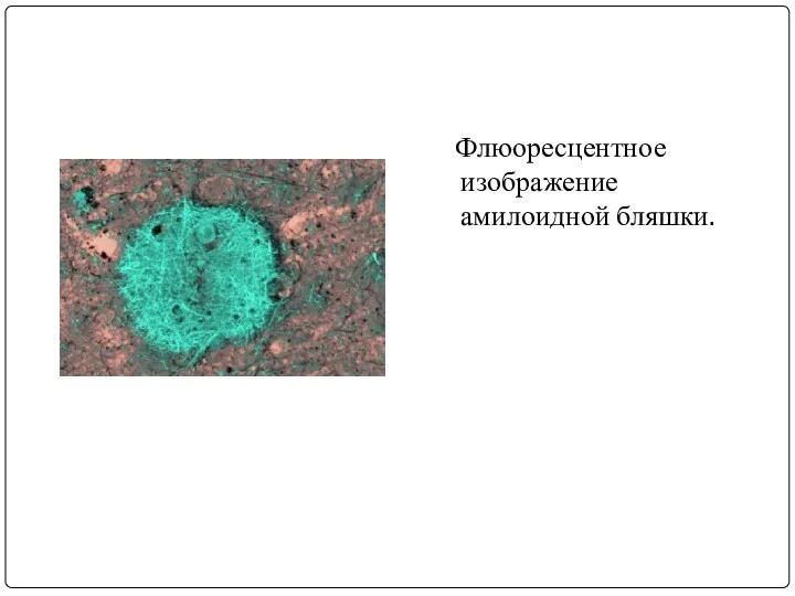 Флюоресцентное изображение амилоидной бляшки.