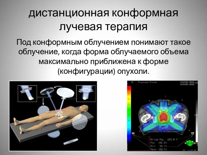 дистанционная конформная лучевая терапия Под конформным облучением понимают такое облучение, когда форма облучаемого