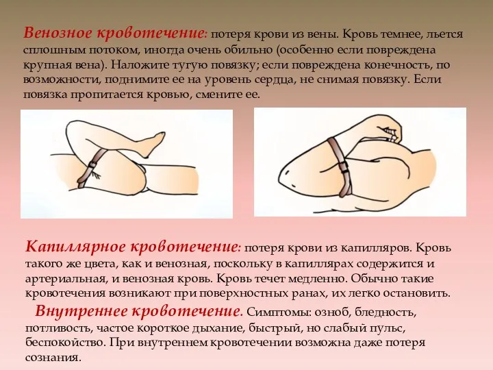 Венозное кровотечение: потеря крови из вены. Кровь темнее, льется сплошным